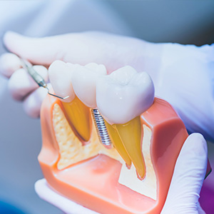The image shows a dental implant being prepared or installed, with visible screws and a tooth model in an open mouth model.