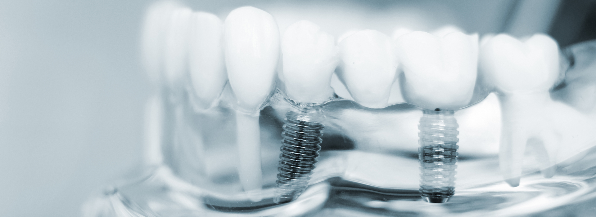 An up-close view of a dental implant with screws and a clear plastic cover, showcasing the technology used in oral health care.