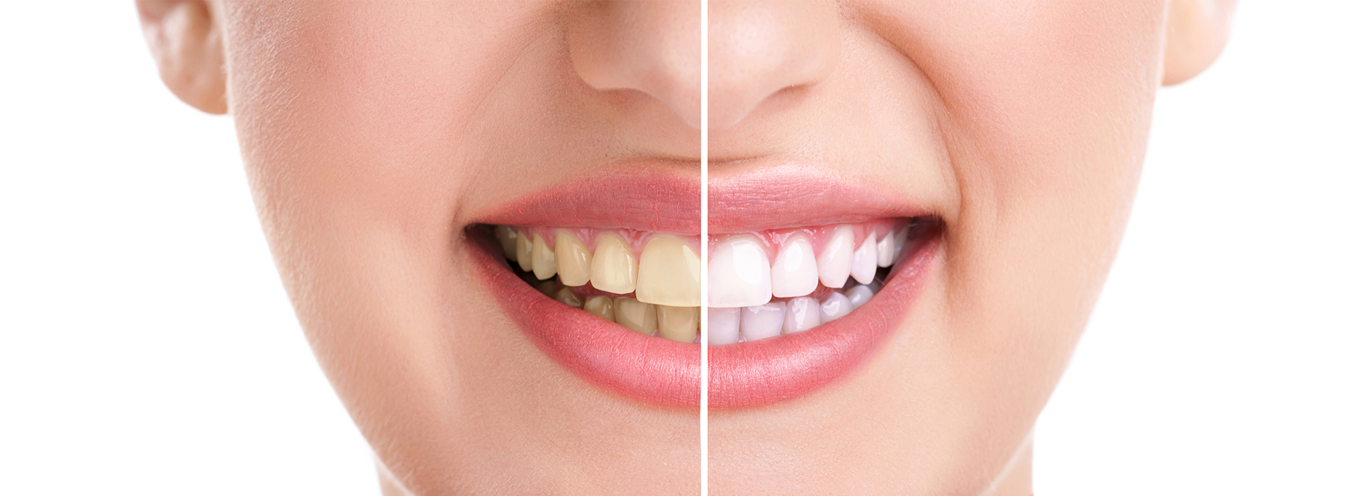 The image is a before and after comparison of a person s teeth, showcasing the result of dental treatment.